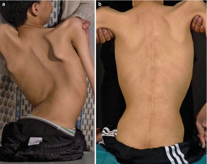 Surgical Management of Neuromuscular Scoliosis | SpringerLink