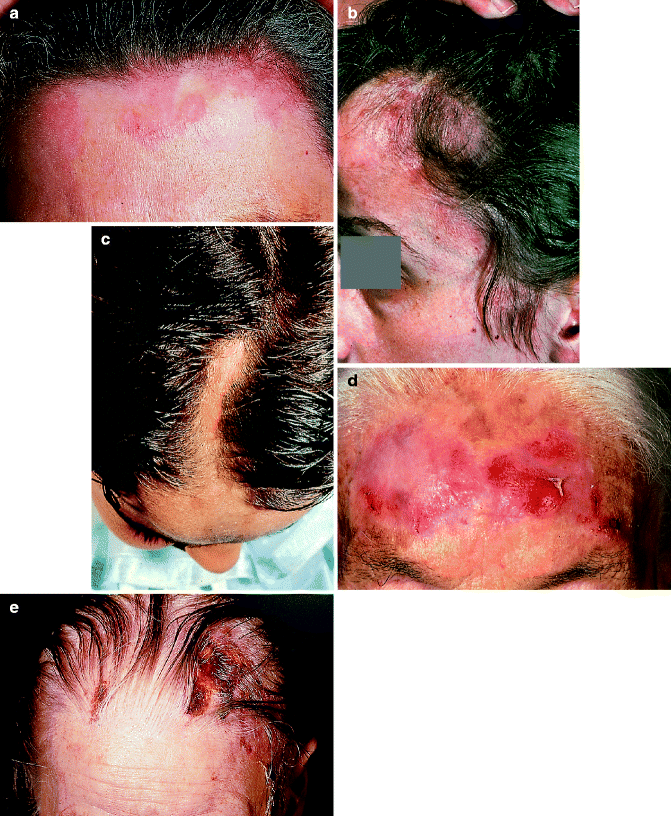 scarring hair loss icd 10