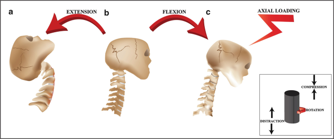 Neck condition: a) neck extension; b) normal; c) neck flexion [4].