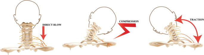 What are Stingers in the Neck? - Orthopaedic Specialty Group
