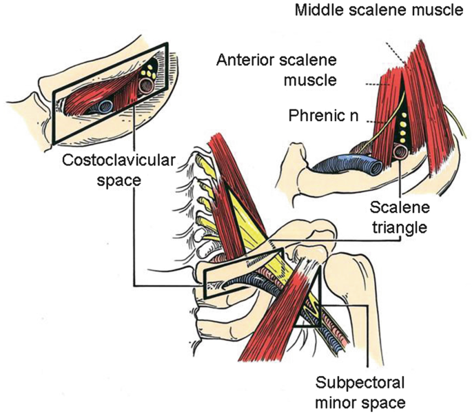 Thoracic Outlet Compression Syndrome and Its Surgical Treatment
