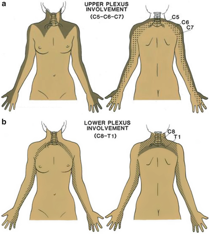 Figure 4 from Thoracic outlet syndrome.