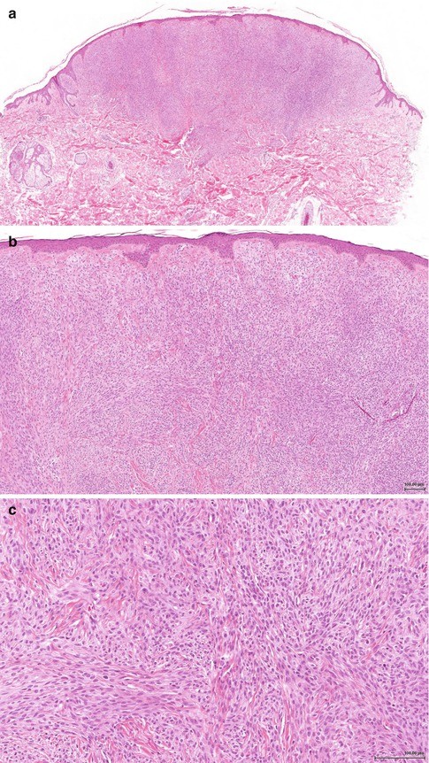 Tinea Nigra Workup: Procedures, Histologic Findings