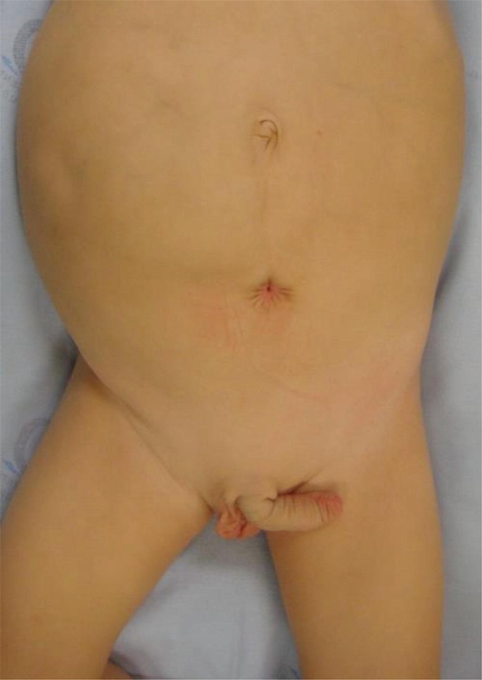 Prune-Belly Syndrome | Springer Nature Link