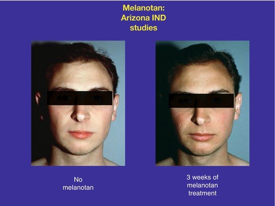 Skin Cancer Prevention