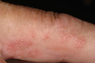 Acute and Recurrent Vesicular Hand Eczema | SpringerLink