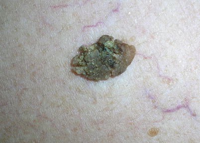Benign Epidermal Tumors Springerlink