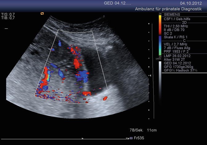 An unusual cause of urinary retention in early pregnancy