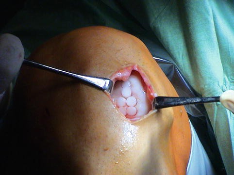 Surgical Techniques in Cartilage Repair Surgery: Osteochondral Autograft  Transfer (OATS, Mosaicplasty) | SpringerLink