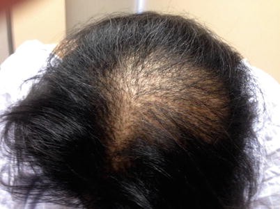 Central Centrifugal Cicatricial Alopecia | SpringerLink Central Centrifugal Cicatricial Alopecia | SpringerLink