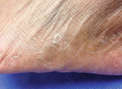 Tinea Versicolor – Appalachian Spring Dermatology