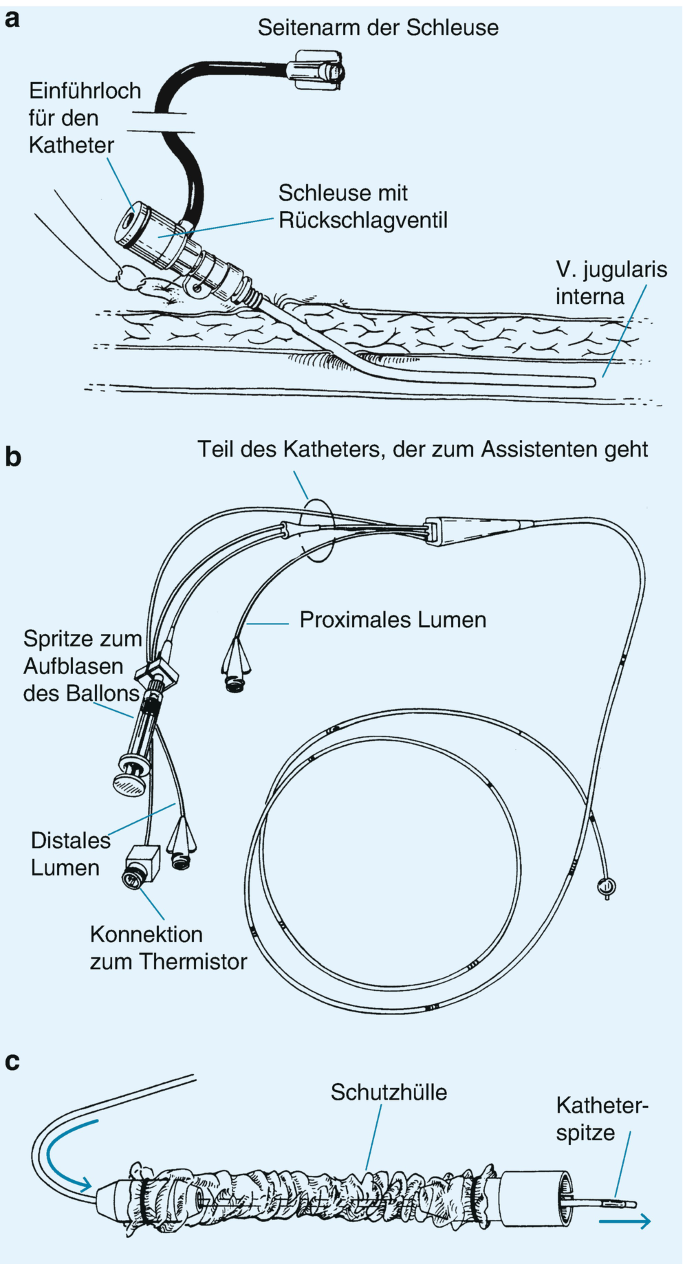 Katheter in der Intensivmedizin | Springer Nature Link (formerly  SpringerLink), image size:685x1264