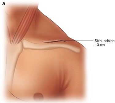 Nerve Entrapment at Shoulder and Arm