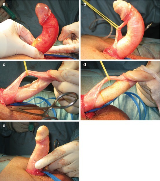 Peyronie's Disease | Springer Nature Link