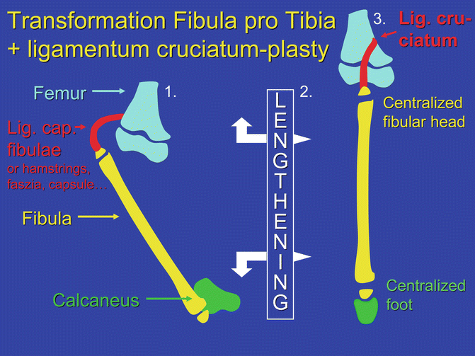 A CASE OF UNILATERAL TIBIAL HEMIMELIA WITH UNILATERAL RADIAL CLUB