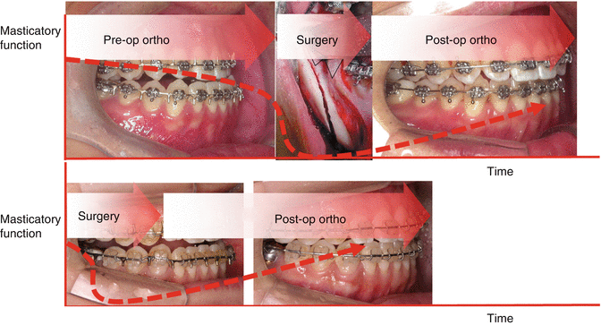 Pre-orthodontic treatments  Dental procedures before aligners 🦷