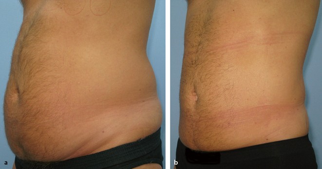 vibrations assistierte liposuktion Ästhetische Chirurgie + Liposuktion