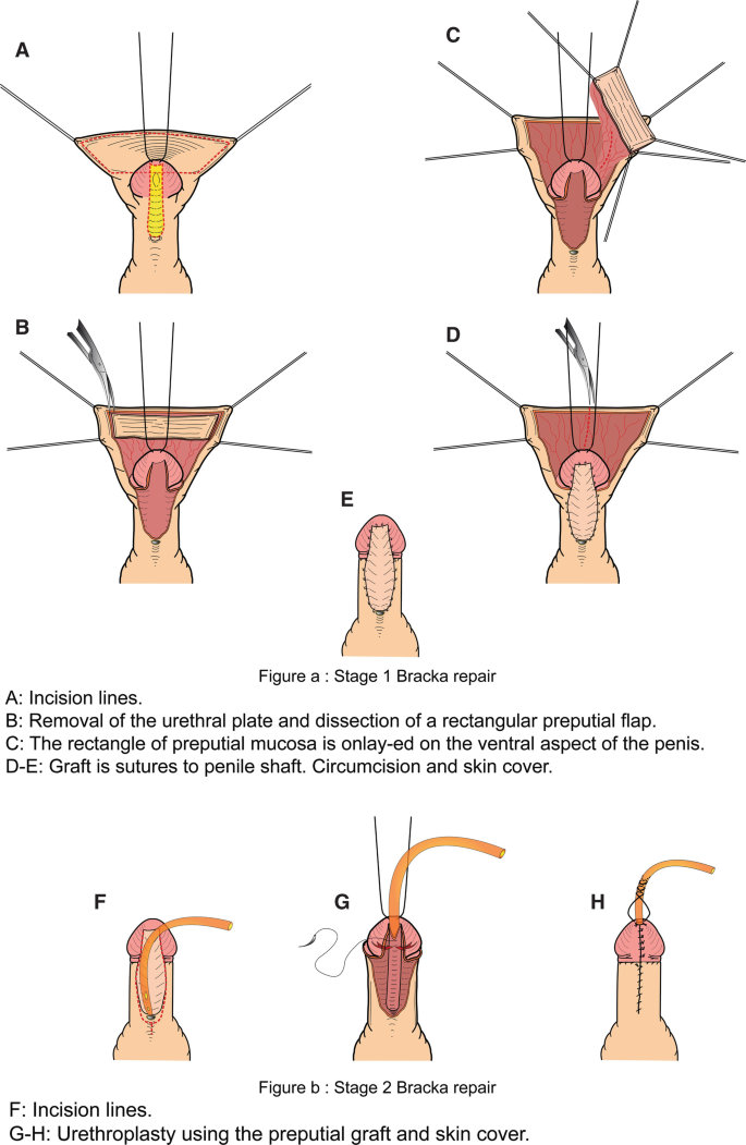 Foreskin is retracted under anesthesia with constriction of the penile