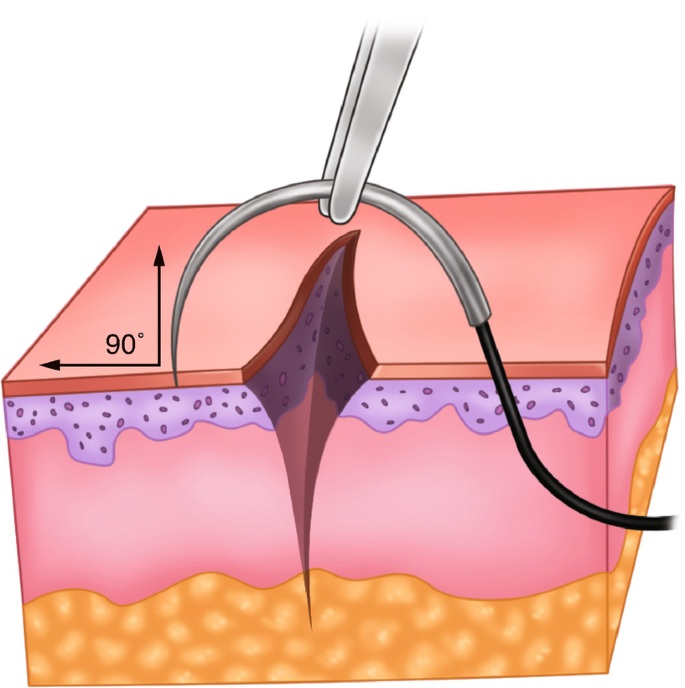 a A temporary-traction 4/0 silk suture is placed to evert the
