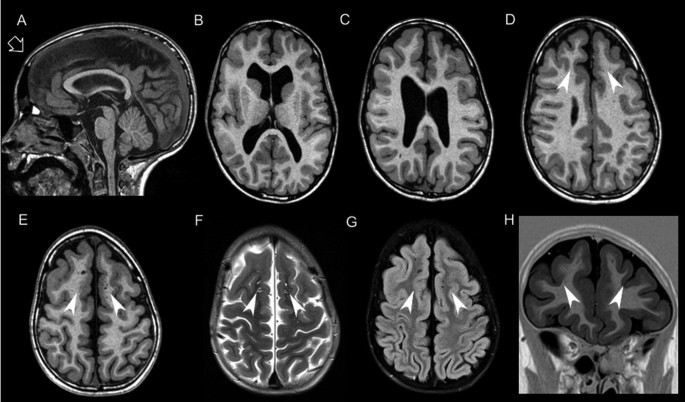 Rubinstein-Taybi syndrome 2 with cerebellar abnormality and neural