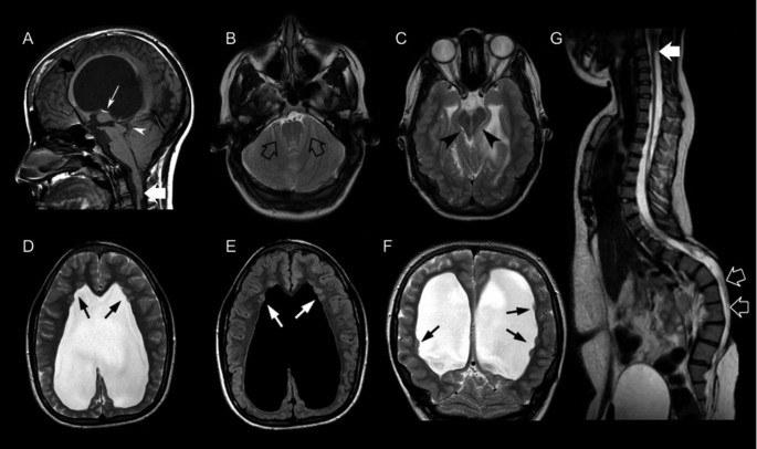 (PDF) Identification of de novo EP300 and PLAU variants in a patient with  Rubinstein–Taybi syndrome-related arterial vasculopathy and skeletal anomaly