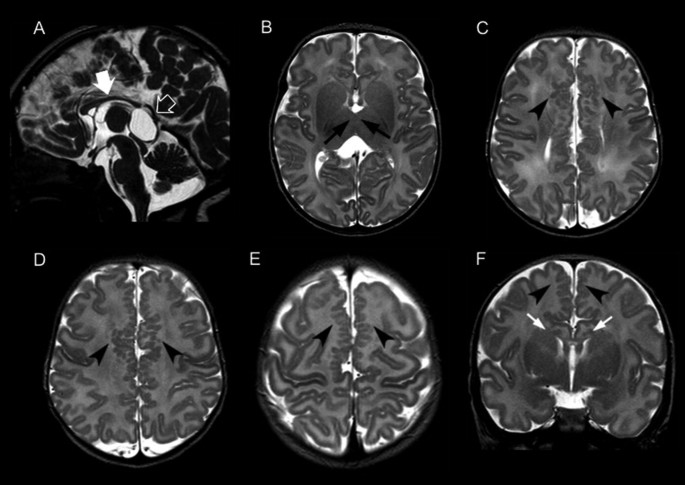 Identification of de novo EP300 and PLAU variants in a patient with  Rubinstein–Taybi syndrome-related arterial vasculopathy and skeletal  anomaly