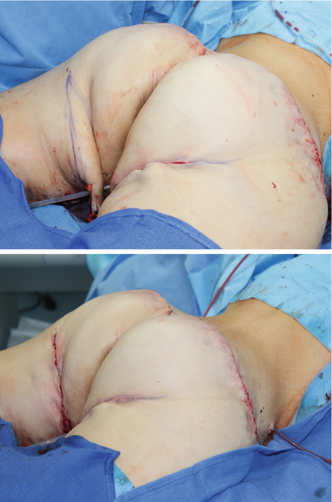 Body Contouring Surgery for Women