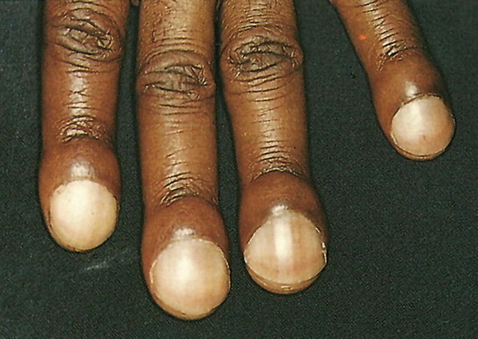 Erkrankungen der Nägel | SpringerLink