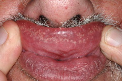 Erkrankungen der Lippen und der Mundhöhle | SpringerLink