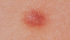 Neoplasien (Tumoren) und tumorähnliche Läsionen der Haut | SpringerLink