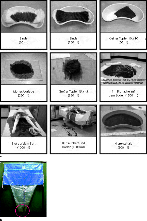Lebensbedrohliche Blutung nach der Geburt des Kindes | Springer Nature Link Lebensbedrohliche Blutung nach der Geburt des Kindes | Springer Nature Link