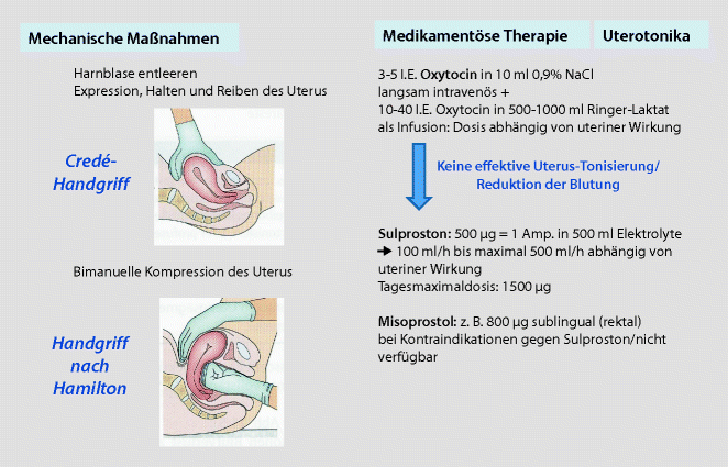 Lebensbedrohliche Blutung nach der Geburt des Kindes | Springer Nature Link Lebensbedrohliche Blutung nach der Geburt des Kindes | Springer Nature Link