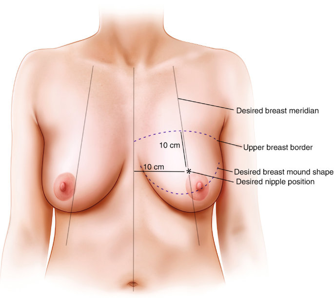 Breast different shapes Ahmed Ali Hassan, MD 
