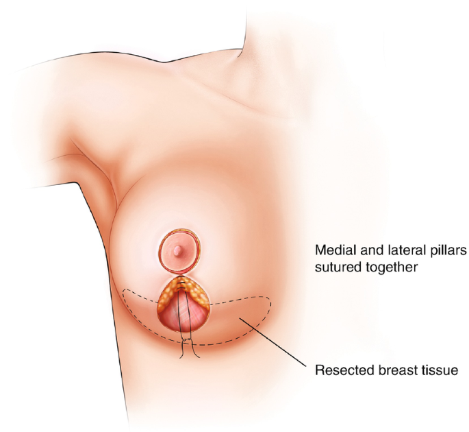 Concepts and Principles of Breast Reduction Surgery