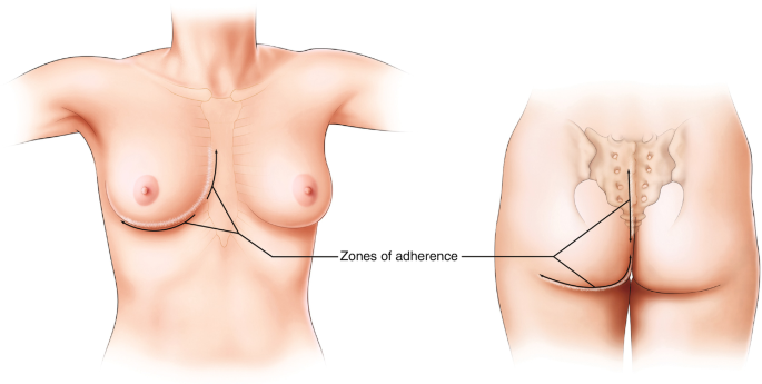 Concepts and Principles of Breast Reduction Surgery