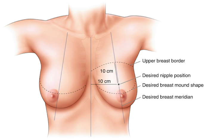 Pendulous breast in supine position without microshell