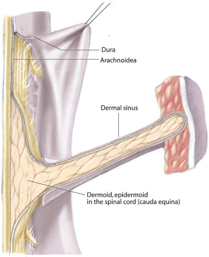 Dermal Sinus | SpringerLink