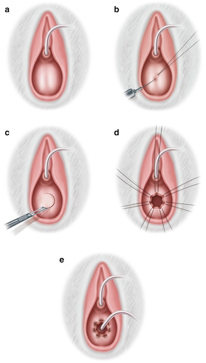 hymenal 