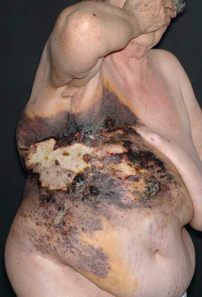 Vascular Tumors