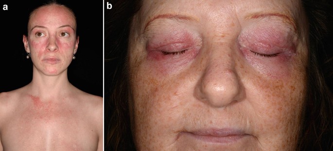 Heliotrope Rash-Myositis- Dermatomyositis-Causes-Diagnosis-Treatment | Homeopathic | Best Homeopathic Doctor in Pakistan | Dr Qaisar Ahmed MD, DHMS