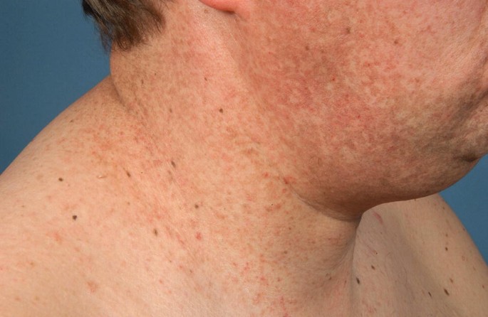 how to use melanotan ii how many mg of melanotan 2 should i take Melanotan-2 10mg