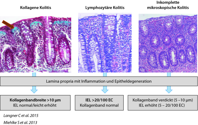 Klinik mikroskopischer Kolitiden und eosinophiler Erkrankungen des  Gastrointestinaltraktes | SpringerLink