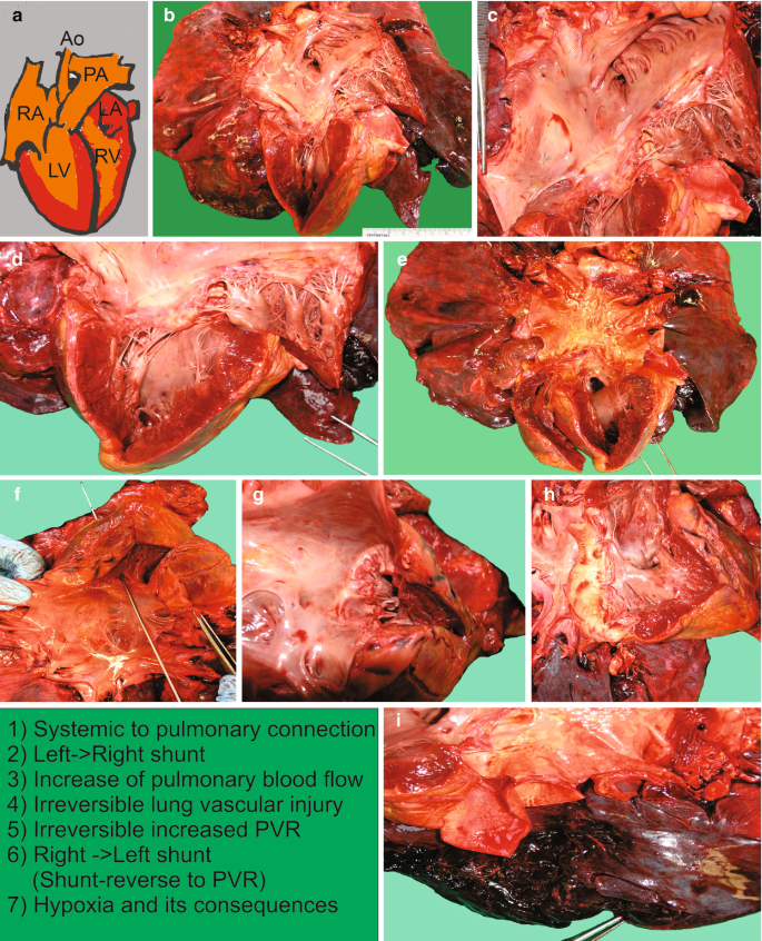 Braz J Cardiovasc Surg - The pulmonary vascular blood supply in the  pulmonary atresia with ventricular septal defect and its implications in  surgical treatment