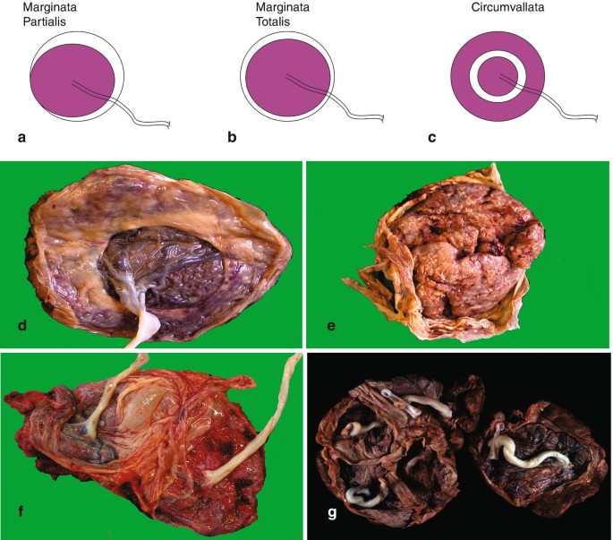 Retromembranous old looking blood clots in the placenta.