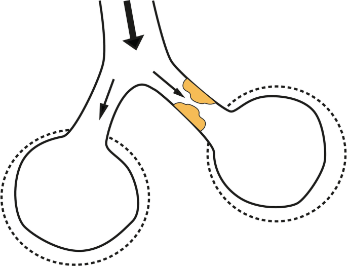 Sekretelimination durch Hustenuntersttzung | Springer Nature Link