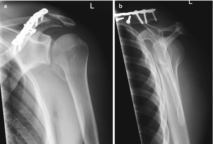 Fraktur des proximalen Humerus