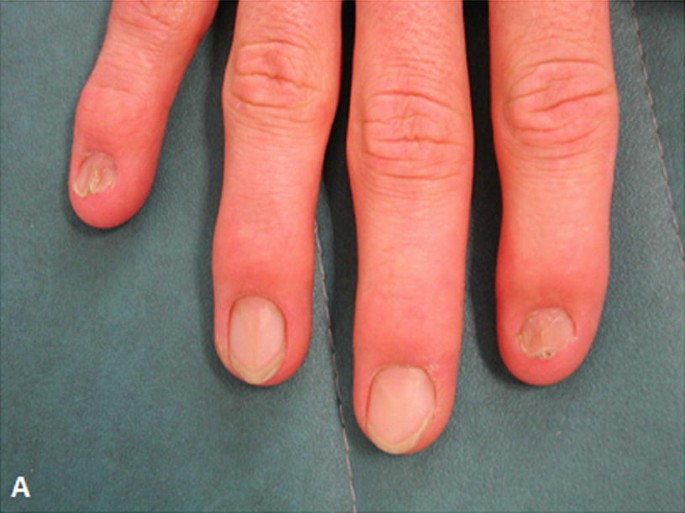 Short Case Discussion : Nail patella Syndrome - YouTube