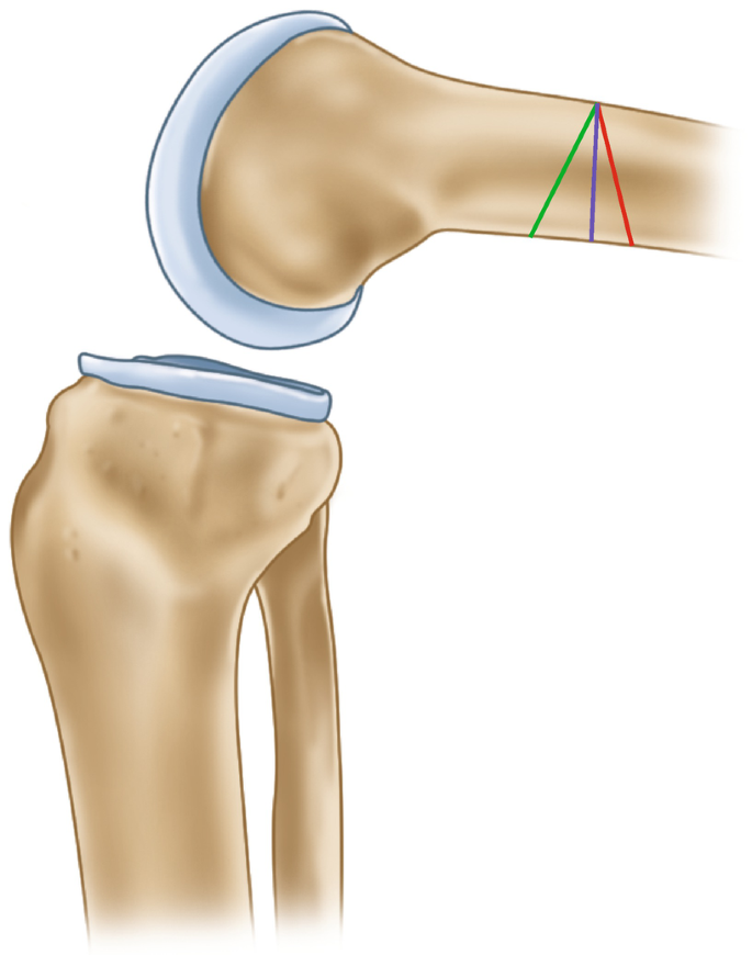 3: Partial frontal cutting of a typical long human bone. Humerus is