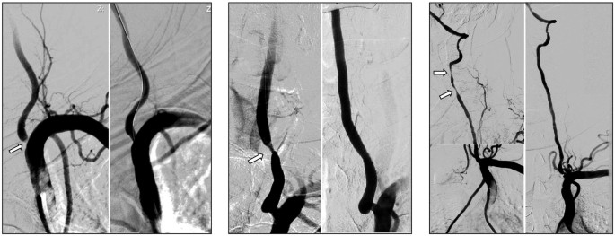 Hypoplasie Arteria Vertebralis Rechts Behandlung link.springer.com