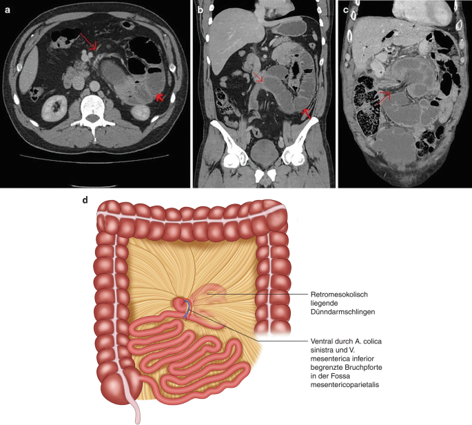 Anatomie der Reparatur von Leistenhernien